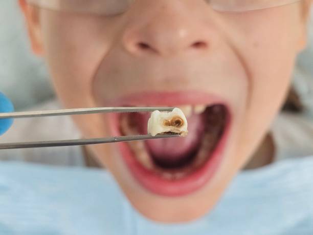 Best Emergency Dental Extractions in Lansdowne, VA
